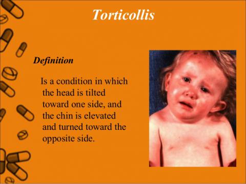 Torticollis (Wryneck): Symptoms, Causes & Treatment